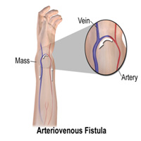 salem-vascular-surgeon-angioplasty